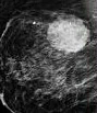 PHYLLODES BREAST TUMOR