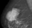 PHYLLODES BREAST TUMOR
