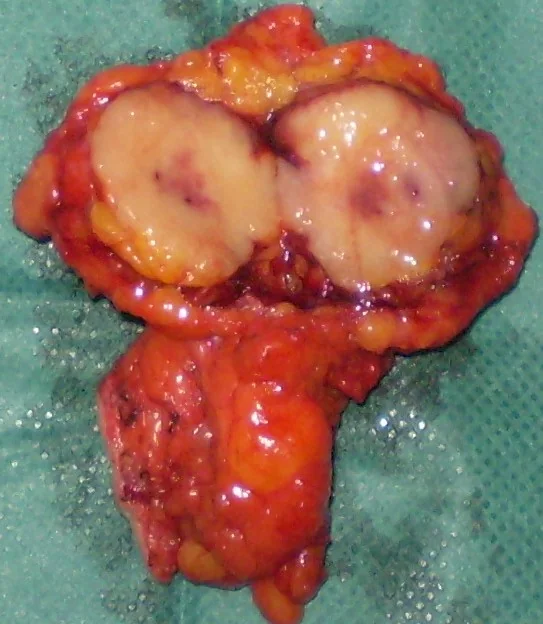 RECCURENCE BREAST CARCINOMA