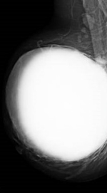 ADENOID CYSTIC CARCINOMA