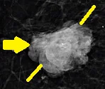 ADENOID CYSTIC BREAST CARCINOMA