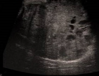 ADENOID CYSTIC CARCINOMA 