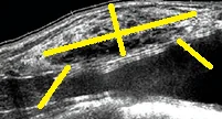 BREAST ANGIOSARCOMA