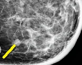 APOCRINE BREAST CARCINOMA