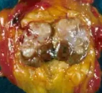 APOCRINE BREAST CARCINOMA