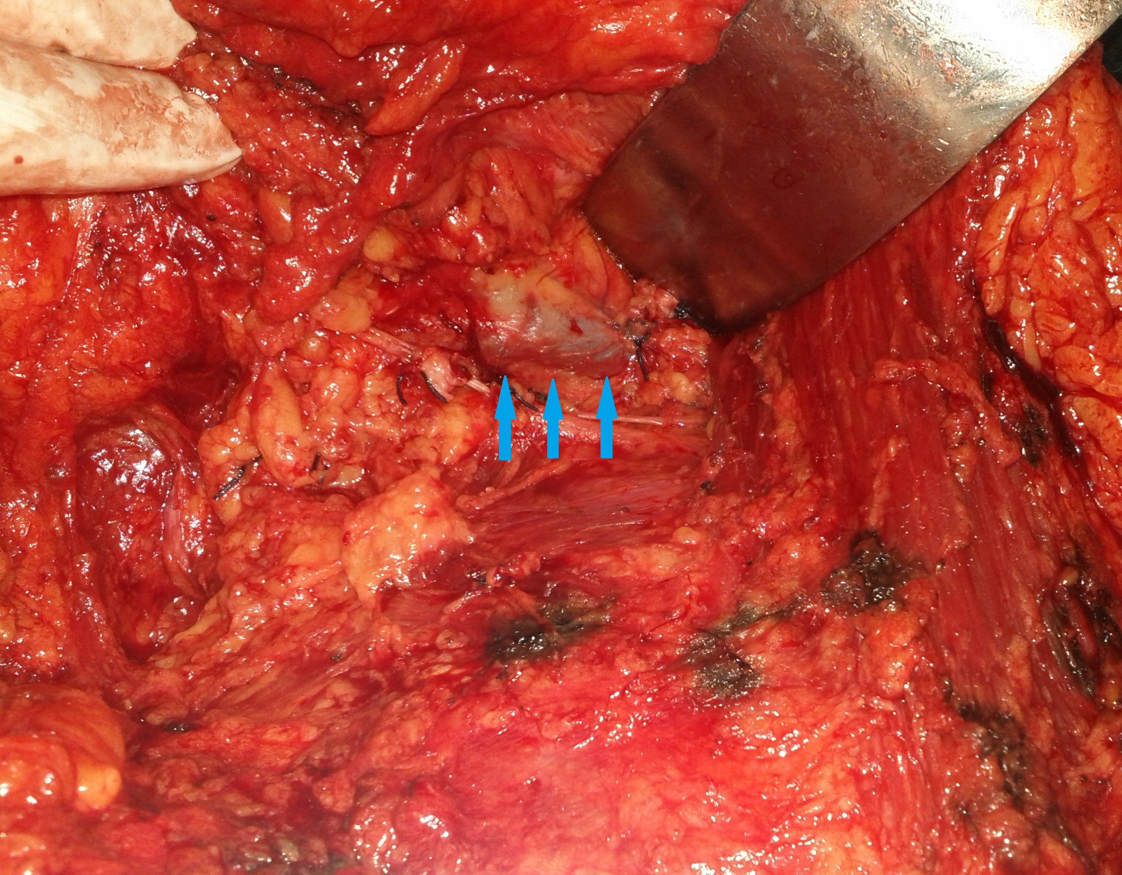 AXILLARY LYMPH NODES DISSECTION - AXILLARY VEIN
