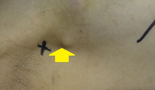AXILLARY SENTINEL NODE