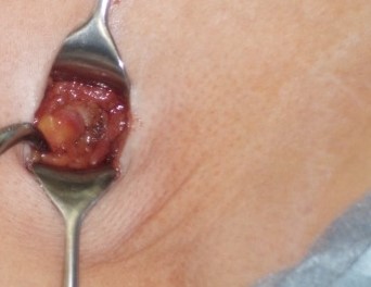AXILLARY SENTINEL NODE DISSECTION