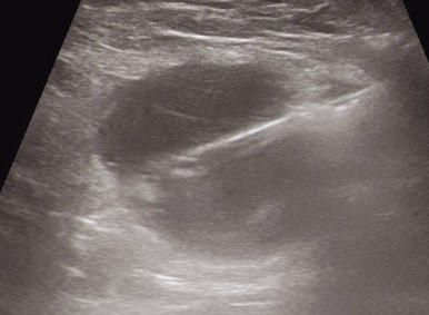 AXILLARY SENTINEL NODE