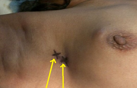 AXILLARY SENTINEL NODES