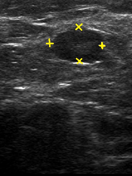 AXILLARY SENTINEL NODE