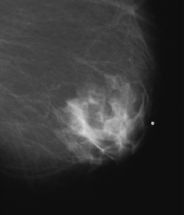 BENIGN MALE BREAST