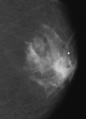 BENIGN MALE BREAST