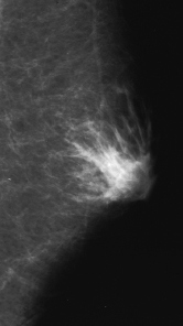 BENIGN MALE BREAST