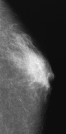BENIGN MALE BREAST
