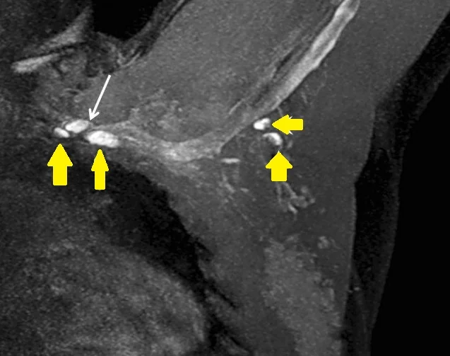 BREAST LYMPHANGIOGRAPHY