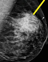 BREAST ABSCESS