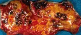 BREAST ANGIOSARCOMA