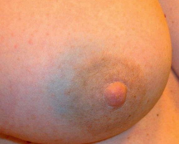 BREAST CARCINOMA - BLUE INJECTION