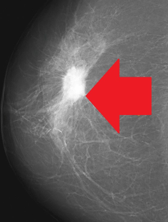 BREAST CARCINOMA
