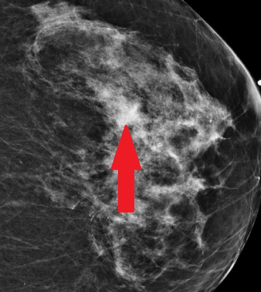 BREAST CARCINOMA