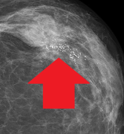 BREAST CARCINOMA - MICROCALCIFICATIONS