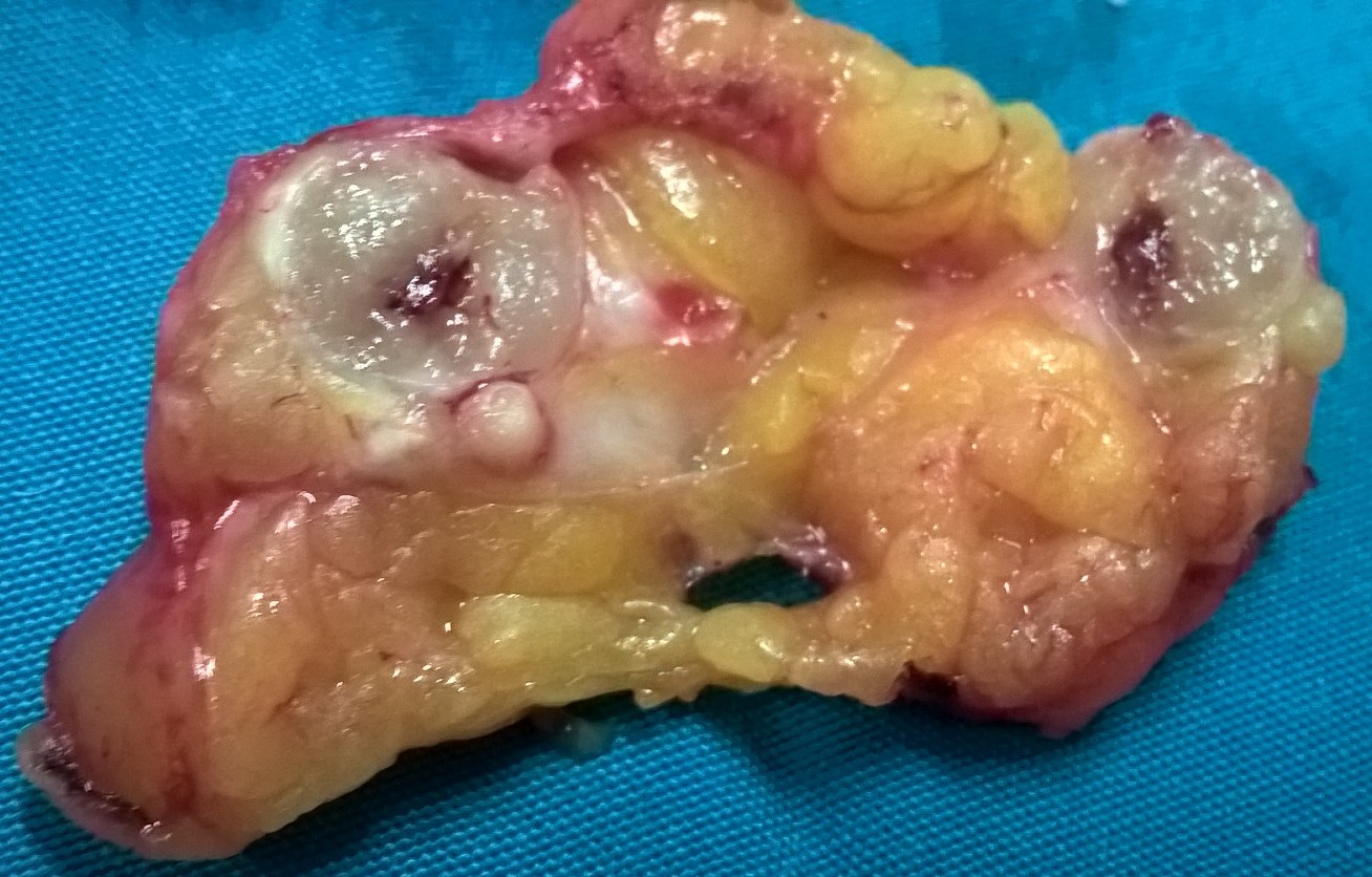 BREAST CARCINOMA