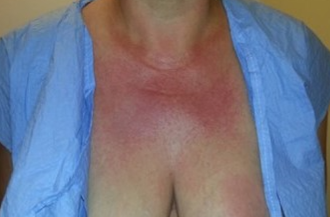 BREAST CARCINOMA - DERMATOMYOSITIS