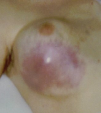 BREAST CHLOROMA - AML