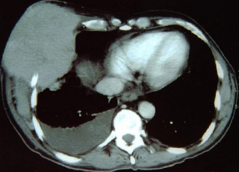 BREAST CHLOROMA