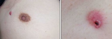 BREAST CUTANEOUS METASTASIS
