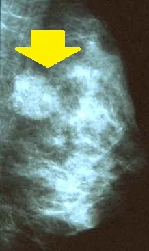 BREAST FIBROADENOMA