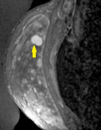 BREAST FIBROADENOMA