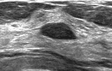 BREAST FIBROADENOMA