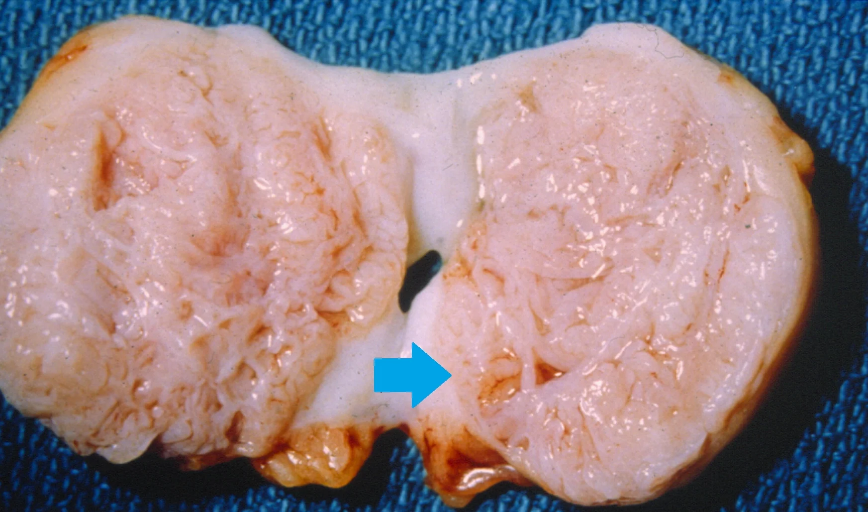 BREAST FIBROADENOMA
