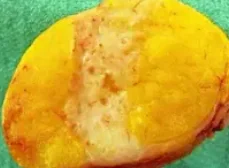 BREAST HAMARTOMA