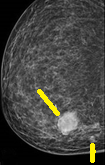 BREAST METASTASIS - RECTAL CARCINOMA