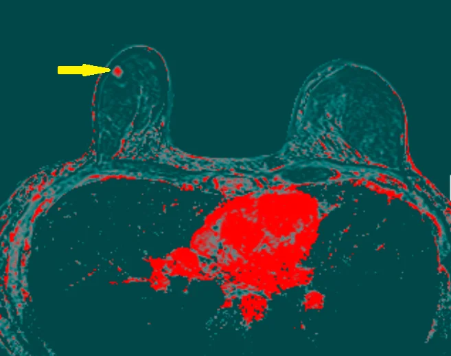 BREAST CARCINOMA