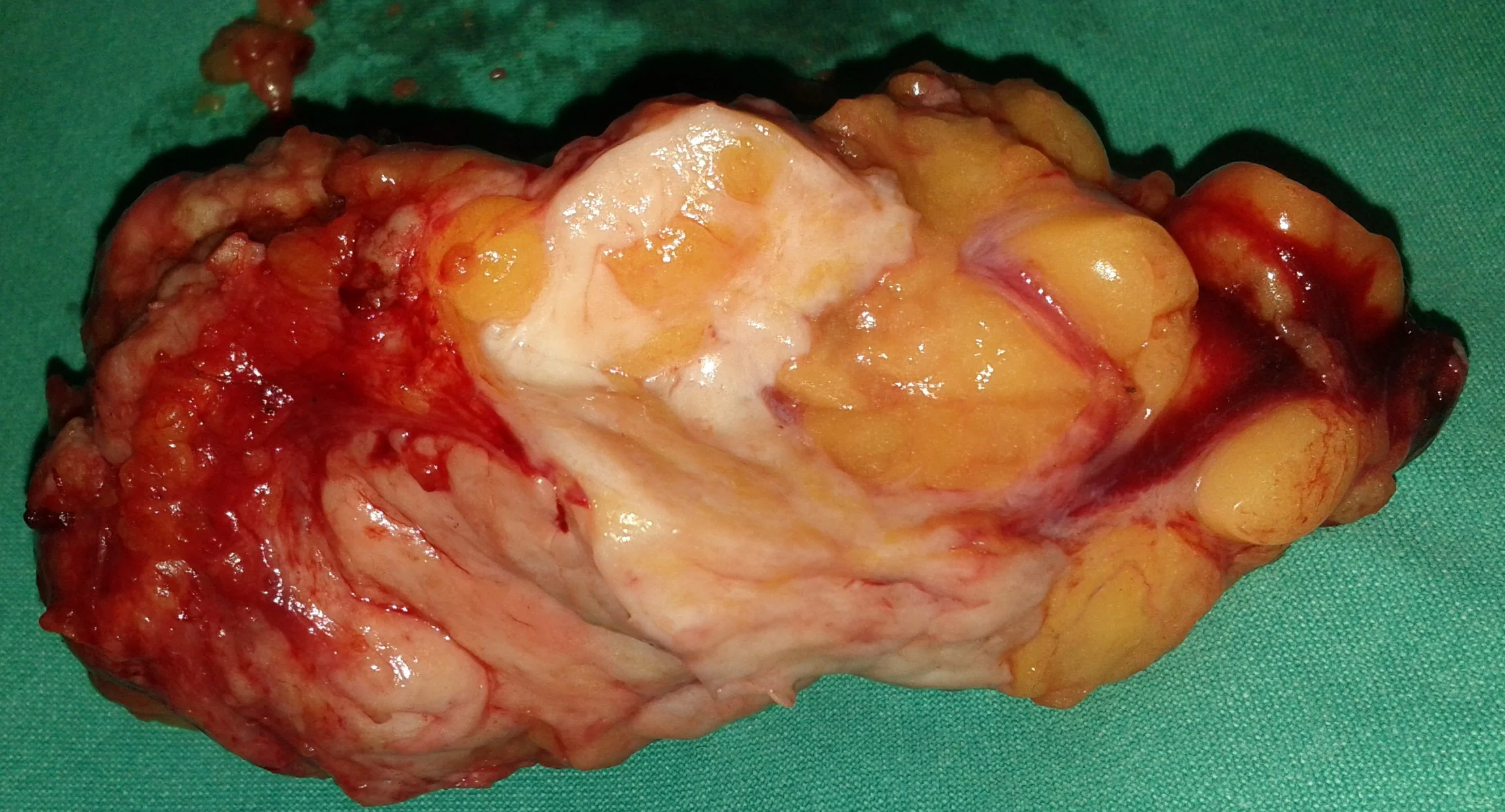 BREAST CARCINOMA