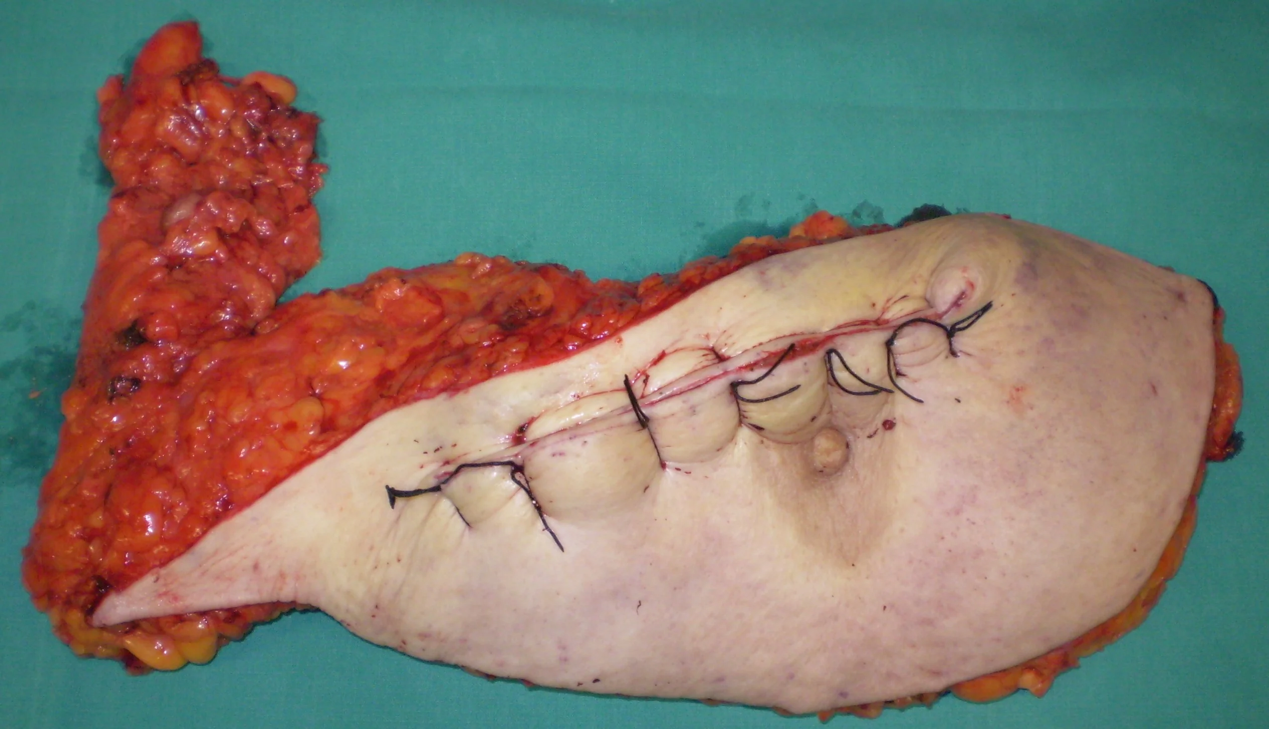 SIMPLE MASTECTOMY - AXILLARY LYMPH NODE DISSECTION