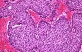 CARCINOID TUMOR OF BREAST