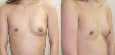 CONGENITAL ABSCESS MAMMARY GLAND