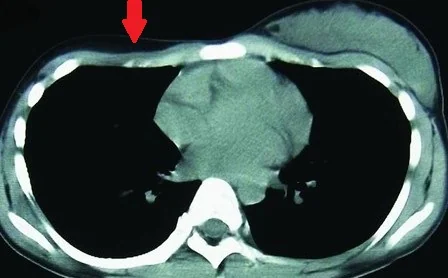CONGENITAL ABSCENCE MAMMARY GLAND