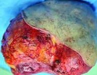 CYSTOSARCOMA PHYLLODES