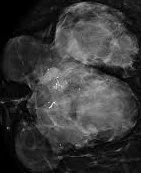 CYSTOSARCOMA PHYLLODES