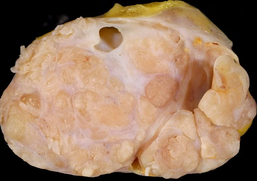 CYSTOSARCOMA PHYLLODES