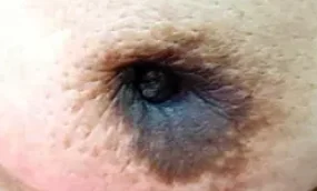 DUCTAL BREAST CARCINOMA 