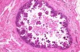 DUCTAL CARCINOMA IN SITU