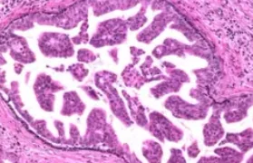 DUCTAL HYPERPLASIA