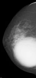 EWING'S BREAST SARCOMA